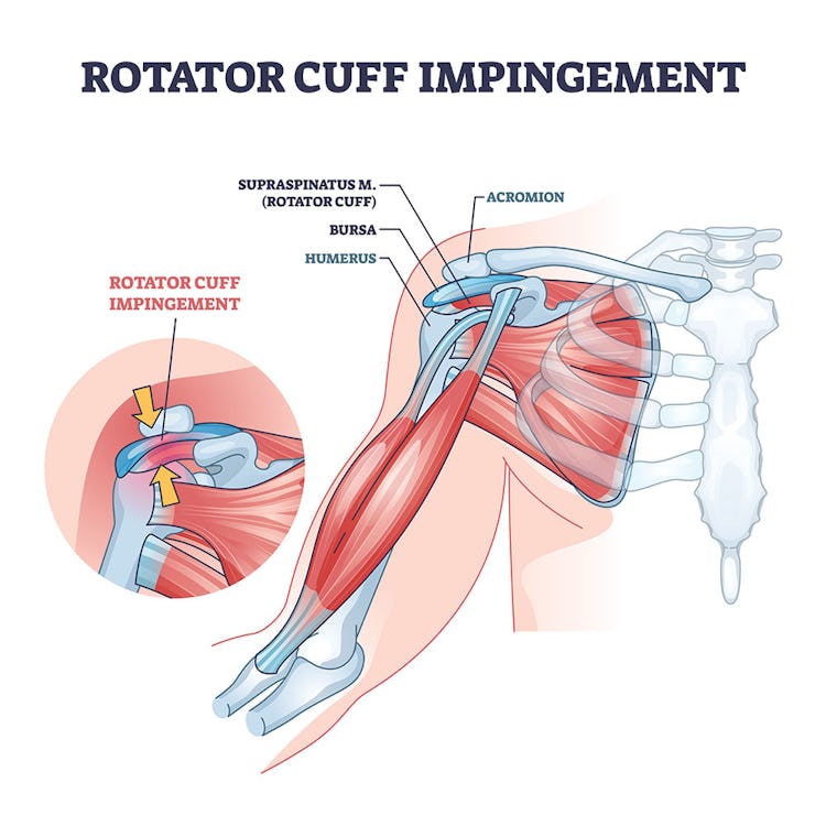 Treatments for a Shoulder Impingement